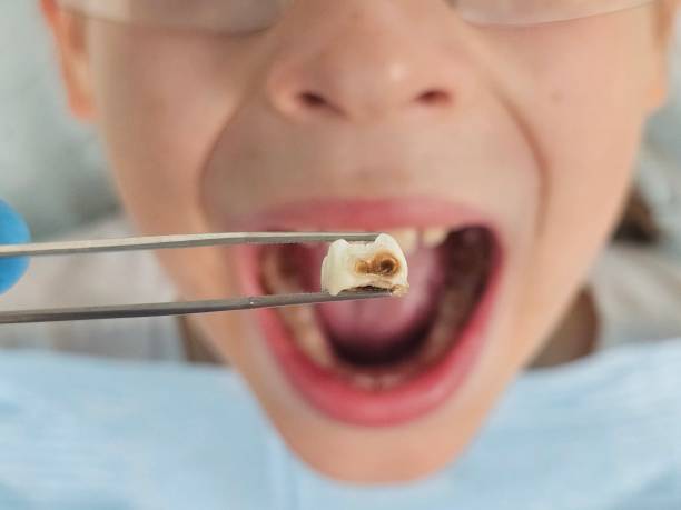 Best Emergency Treatment for Dental Infections or Abscesses in De Leon, TX